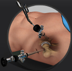 Hip Arthroscopy