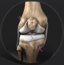 Knee Arthroscopy/Ligament Reconstruction